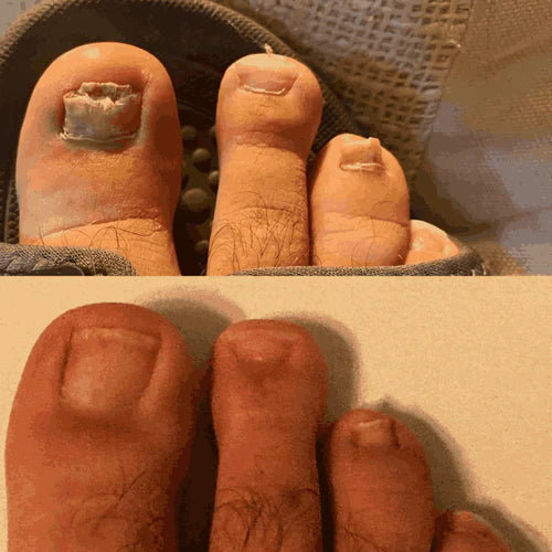 Neoclear™ - Dites adieu aux mycoses des ongles