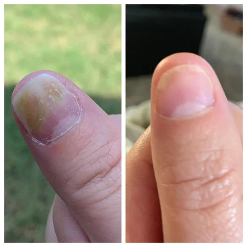 Neoclear™ - Dites adieu aux mycoses des ongles