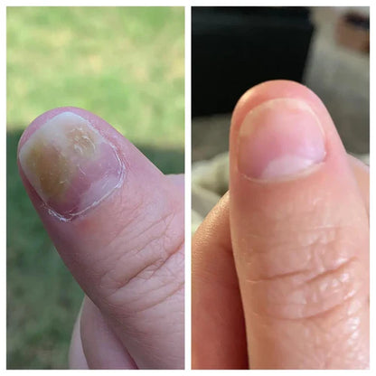 Neoclear™ - Dites adieu aux mycoses des ongles