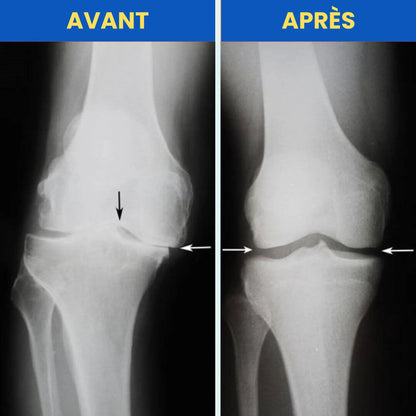 OrthoPosture™ - Dite adieu aux douleurs aux genoux