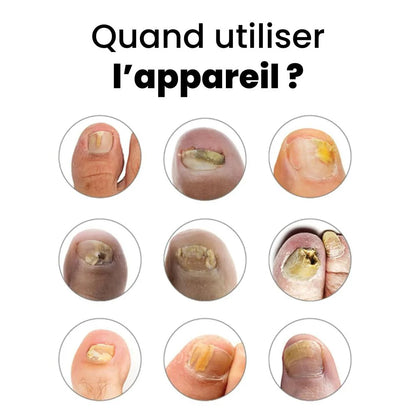 Appareil de traitement des mycoses Orthovita