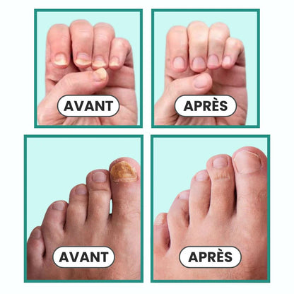 Appareil de traitement des mycoses Orthovita