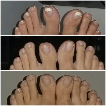 Neoclear™ - Dites adieu aux mycoses des ongles