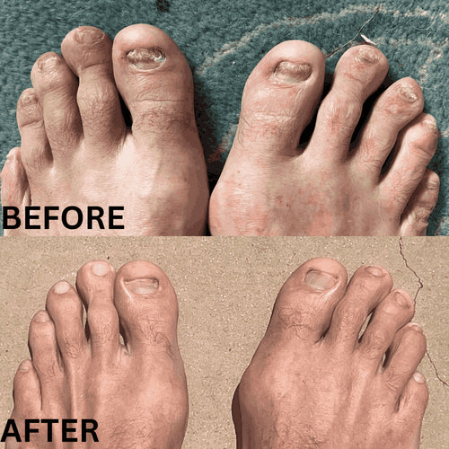 Neoclear™ - Dites adieu aux mycoses des ongles