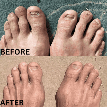 Neoclear™ - Dites adieu aux mycoses des ongles