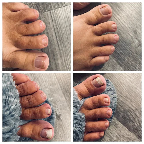 Neoclear™ - Dites adieu aux mycoses des ongles
