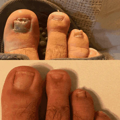 Neoclear™ - Dites adieu aux mycoses des ongles